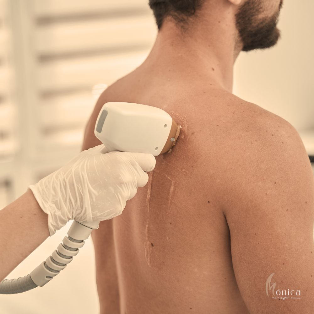 DEPILACION ESPALDA HOMBRE